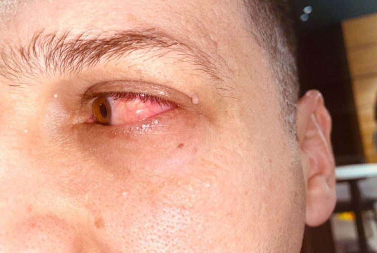 Mjeku tregon simptomat e gripit të syrit: Kujdes, është …
