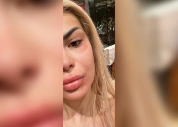 “Ja dola sërish”, Luana shfaqet pa make-up dhe me këmbë të enjtura