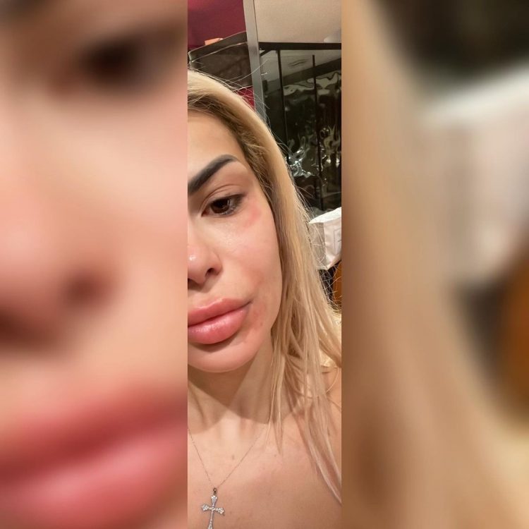 “Ja dola sërish”, Luana shfaqet pa make-up dhe me këmbë të enjtura