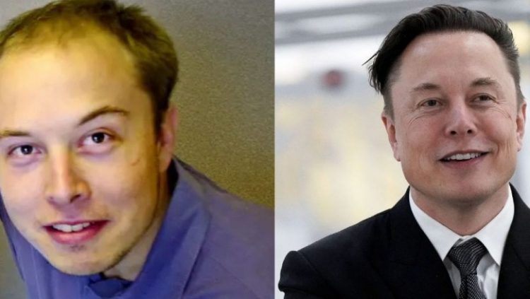 Elon Musk i fixuar, shpenzoi 172 mijë dollarë për t’u dukur më i ri