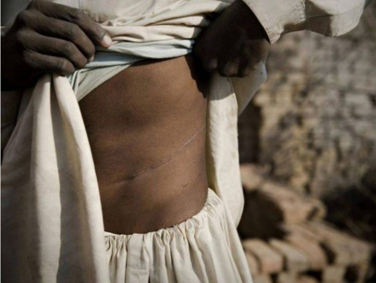 Katër mijë dollorë për një veshkë, si u shkatërrua rrjeti i krimit