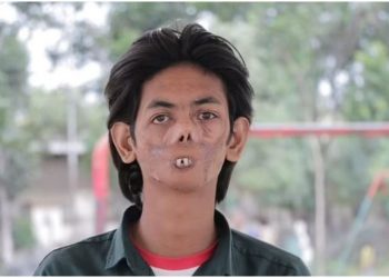 Ujku i hëngri fytyrën, i riu: Njerëzit frikësohen nga unë