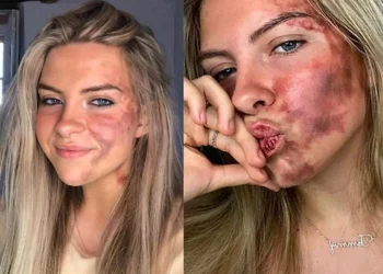 Kujtoi se ishte alergji, modelja tregon se është…