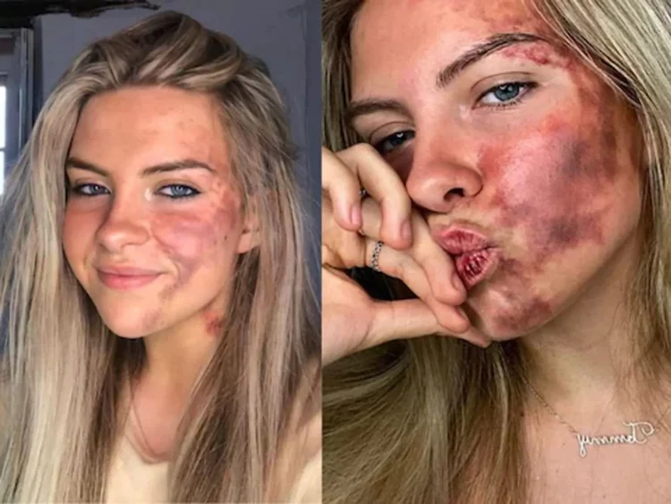 Kujtoi se ishte alergji, modelja tregon se është…