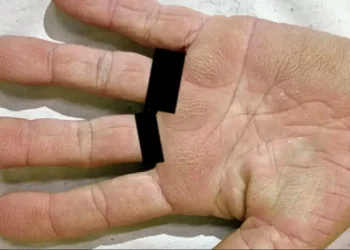 I ishin bërë duart ngjyrë kafe, gruaja zbuloi se kishte problem shëndetësor të rëndë