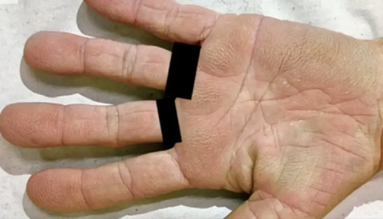 I ishin bërë duart ngjyrë kafe, gruaja zbuloi se kishte problem shëndetësor të rëndë