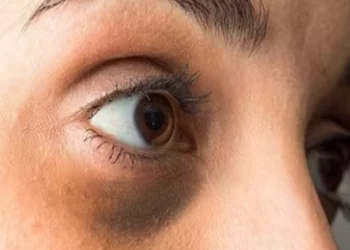 Ja 6 strategji për lehtësimin e simptomave të lodhjes së syve