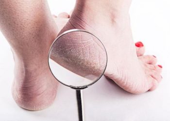 Shëroni thembrat e çara vetëm me… sodë buke