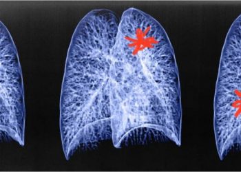 ChatGPT mund të parandalojë kancerin? Ja e vërteta