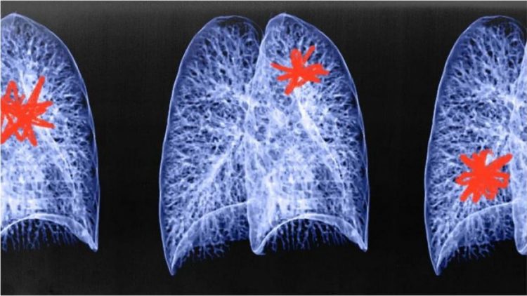 ChatGPT mund të parandalojë kancerin? Ja e vërteta
