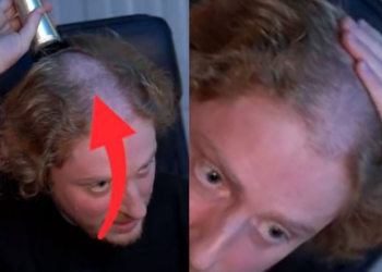 VIDEO/ Mbante kufje për shumë orë në ditë, i deformohet koka