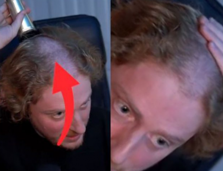 VIDEO/ Mbante kufje për shumë orë në ditë, i deformohet koka