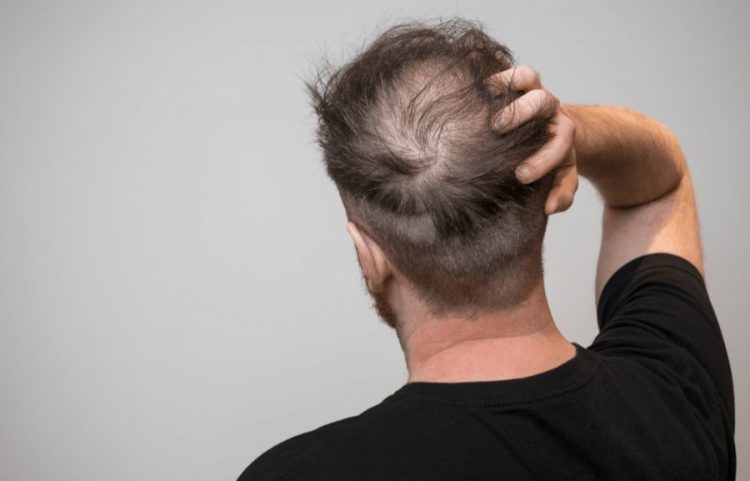 Ja disa udhëzime për të evituar rënien e flokëve