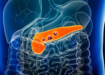 Cilat janë shenjat dhe simptomat e kancerit të pankreasit