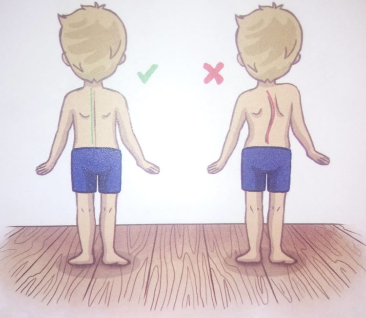 Studimi: Skolioza tek fëmijët 55% të prekur deri 12 vjeç,