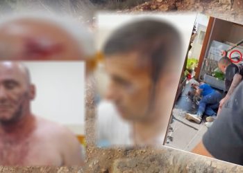 KUJDES PAMJE TË RËNDA, dalin fotot e të plagosurve nga dhuna e vëllait të deputetit dhe grupit me shkop bejsbolli