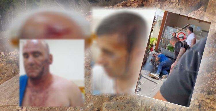 KUJDES PAMJE TË RËNDA, dalin fotot e të plagosurve nga dhuna e vëllait të deputetit dhe grupit me shkop bejsbolli