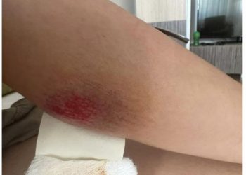 Gruaja shtatzanë sulmohet nga qentë në Prishtinë