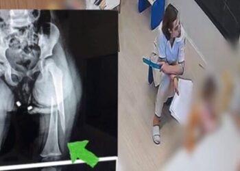 Dhunoi 3-vjeçaren, edukatorja s’ndryshon qëndrim: Këmbën e dëmtoi…