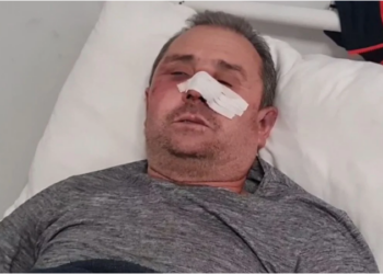 U bë për spital nga hajdutët, 54-vjeçari: Më goditën me qytën e armës