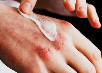 Trajtimet më efektive për ekzemën sipas shkencës