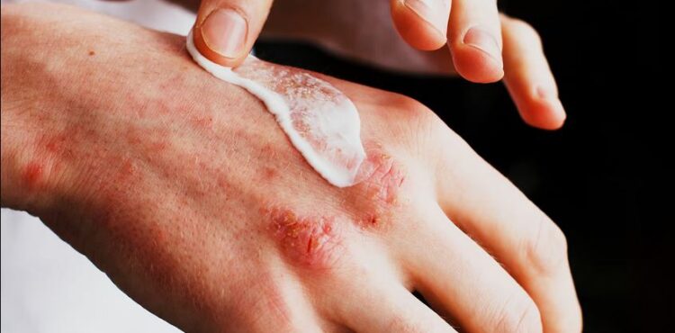 Trajtimet më efektive për ekzemën sipas shkencës