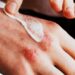 Trajtimet më efektive për ekzemën sipas shkencës