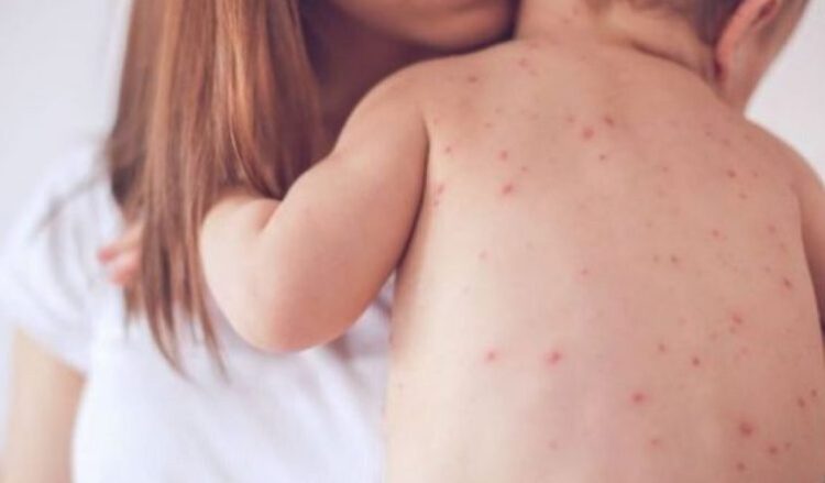 Rritje e rasteve në të gjithë vendin, shpallet epidemia e fruthit