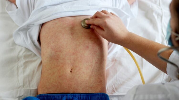 Fruthi hyn në Shqipëri, konfirmohen rastet e para në Tiranë e Durrës