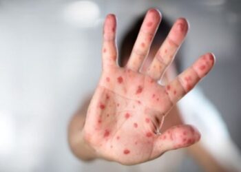 Rastet me fruth në vend, rriten kërkesat për vaksinim në Berat