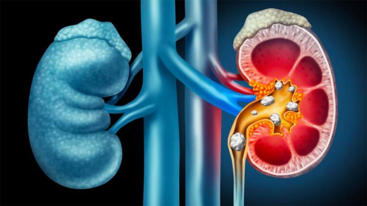 Ndikimi i kanellës në shëndetin e veshkave, ja përfitimet