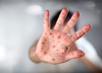 Rasti i parë me fruth në Shkodër, i infektuar një 4-vjeçar