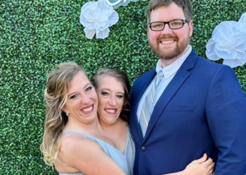 VIDEO-Martohet njëra prej motrave siameze, si funksionon trupi i tyre