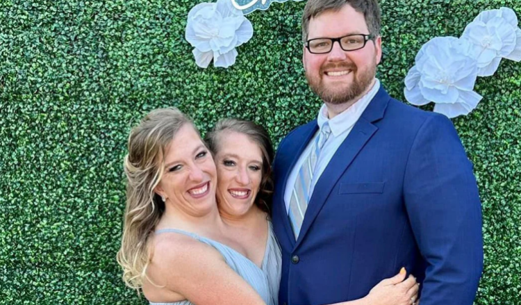 VIDEO-Martohet njëra prej motrave siameze, si funksionon trupi i tyre