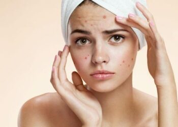 I dinit?! Këto janë 5 shkaqet e shpërthimit të akneve