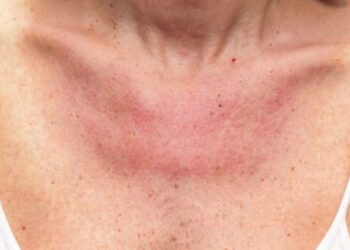 Si të mbrojmë veten këtë verë nga rrezet UV për të parandaluar tumoret