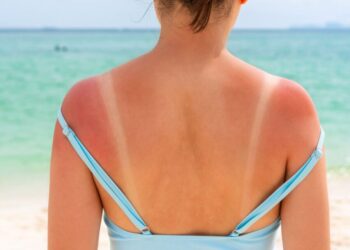 Plane për plazh në fundjavë? Ja 4 mënyrat për të shmangur djegien nga dielli