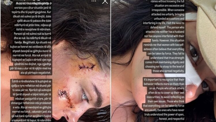 U dhunua nga motrat Berishaj/ Klea Prenga me qepje në fytyrë reagon sërish: Ajo nuk ka burrë…