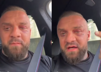 (VIDEO) Me plagë ende të pashëruara ne fytyrë, Medi Iseni shfaqet për herë të parë pas sherrit me Noizy-n