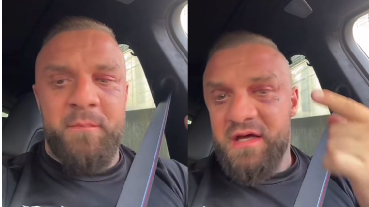 (VIDEO) Me plagë ende të pashëruara ne fytyrë, Medi Iseni shfaqet për herë të parë pas sherrit me Noizy-n