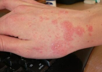 Shpërthen zgjebja në Shqipëri, dermatologia: Si të veproni nëse prekeni