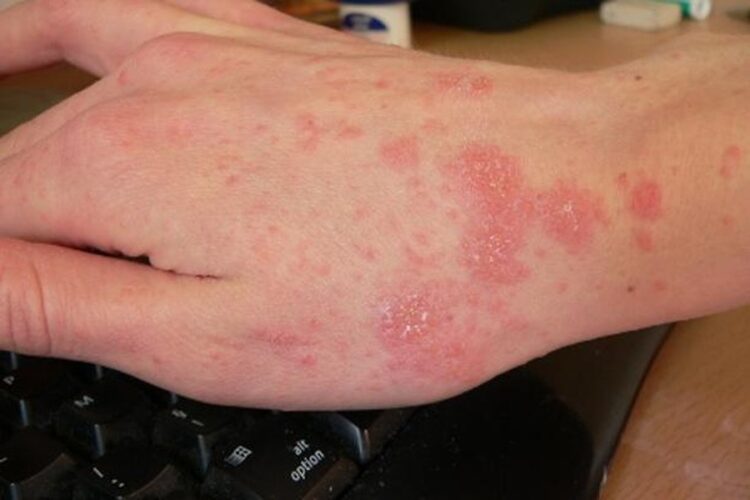 Shpërthen zgjebja në Shqipëri, dermatologia: Si të veproni nëse prekeni