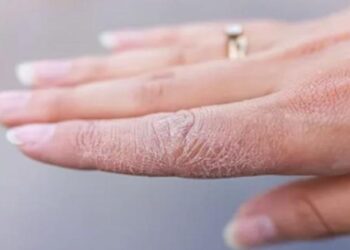 Lëkura e ashpër nga i ftohti, kur është e rrezikshme dhe si ta trajtoni