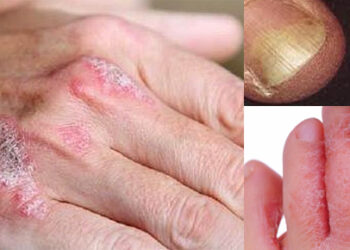 Nuk i kushtiojmë rëndësi, kjo pandemi e heshtur po ‘vret’, infeksionet mykotike shkaku i dhjetra sëmundjeve
