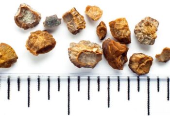 Si të kuptoni nëse keni gurë në veshka! Çfarë duhet të bëni