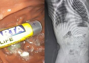 Ndodh në Kosovë/ Fëmijës 2-vjeçar i nxirret bateria e telekomandës nga stomaku (FOTO)