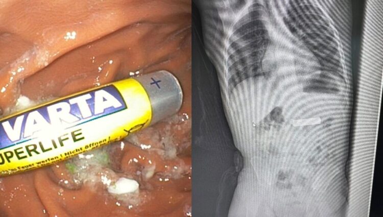 Ndodh në Kosovë/ Fëmijës 2-vjeçar i nxirret bateria e telekomandës nga stomaku (FOTO)