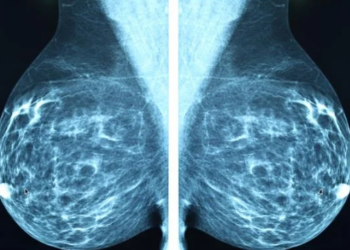 Inteligjenca Artificiale zbulon kancerin e gjirit përpara se të shfaqet