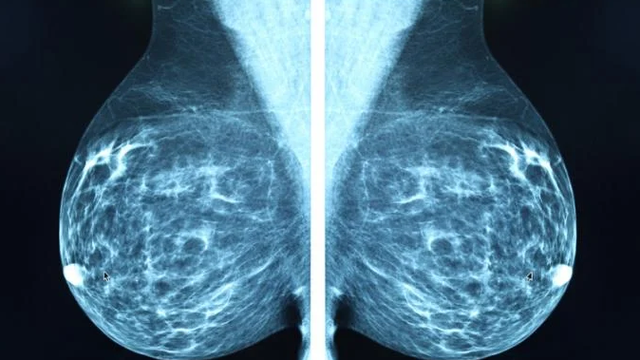 Inteligjenca Artificiale zbulon kancerin e gjirit përpara se të shfaqet