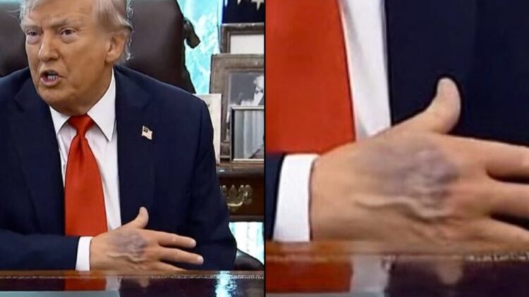 Foto/ Dora e nxirë e Donald Trump bën xhiron e rrjetit, Shtëpia e Bardhë sqaron gjendjen shëndetësore të Presidentit amerikan